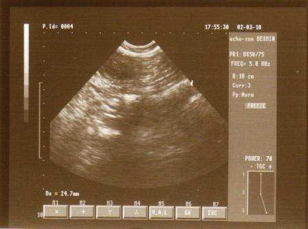 USG 22-24 dzień ciąży